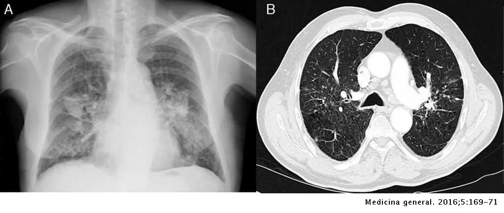 polvo de vidrio en los pulmones - Cómo saber si tengo polvo en los pulmones