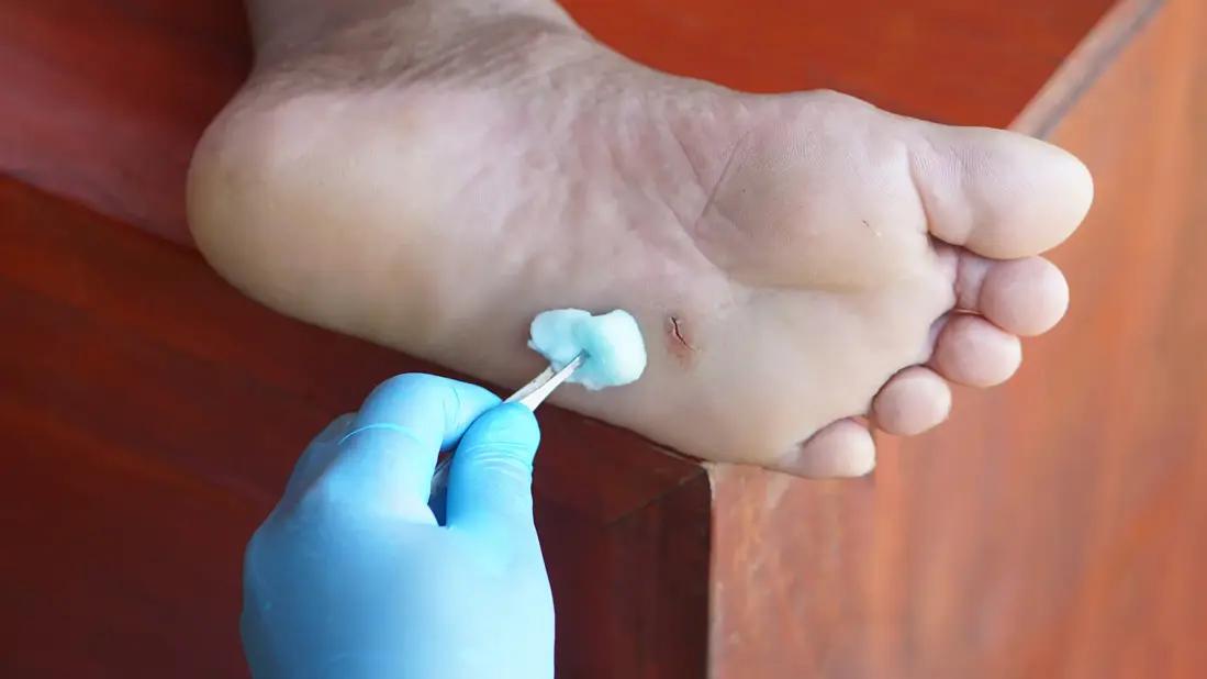 vidrio en la planta del pie - Cómo sacar el vidrio profundo de los pies