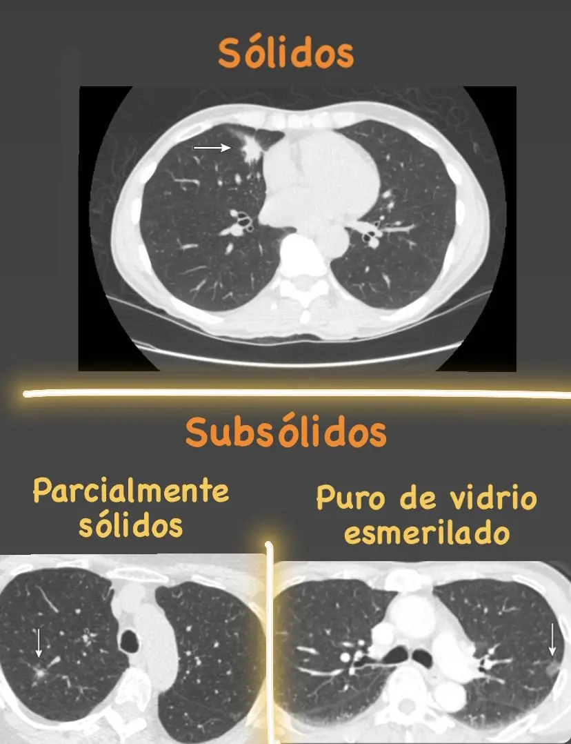 nodulo subsolido en vidrio esmerilado - Cuándo un nódulo pulmonar es sospechoso