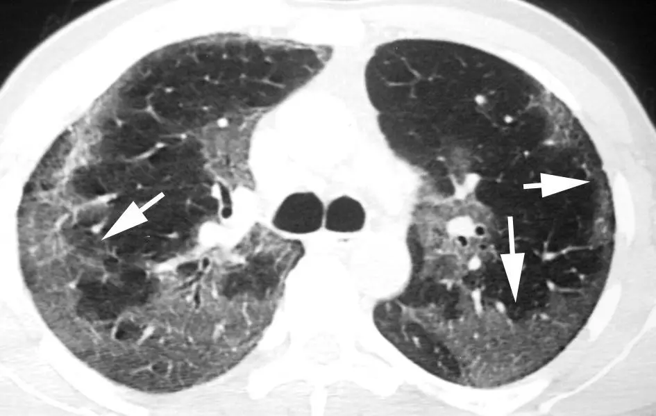 vidrio despulido en pulmon - Qué causa un infiltrado pulmonar