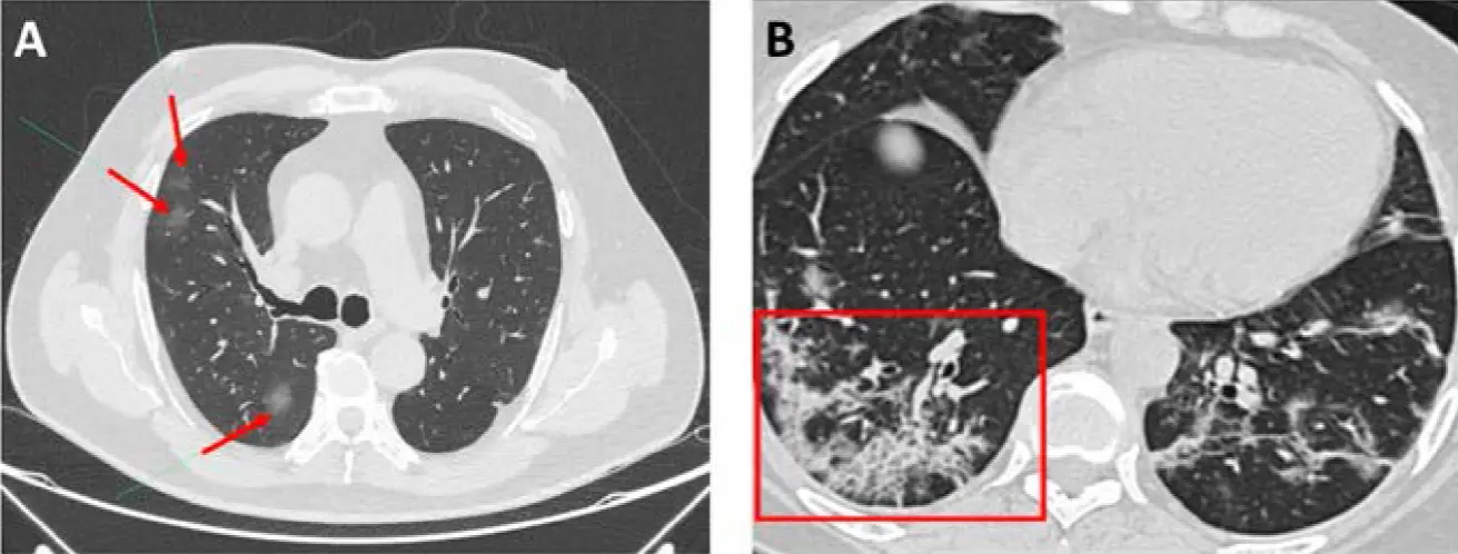 parenquima pulmonar vidrio esmerilado - Qué es una lesión parenquimatosa pulmonar