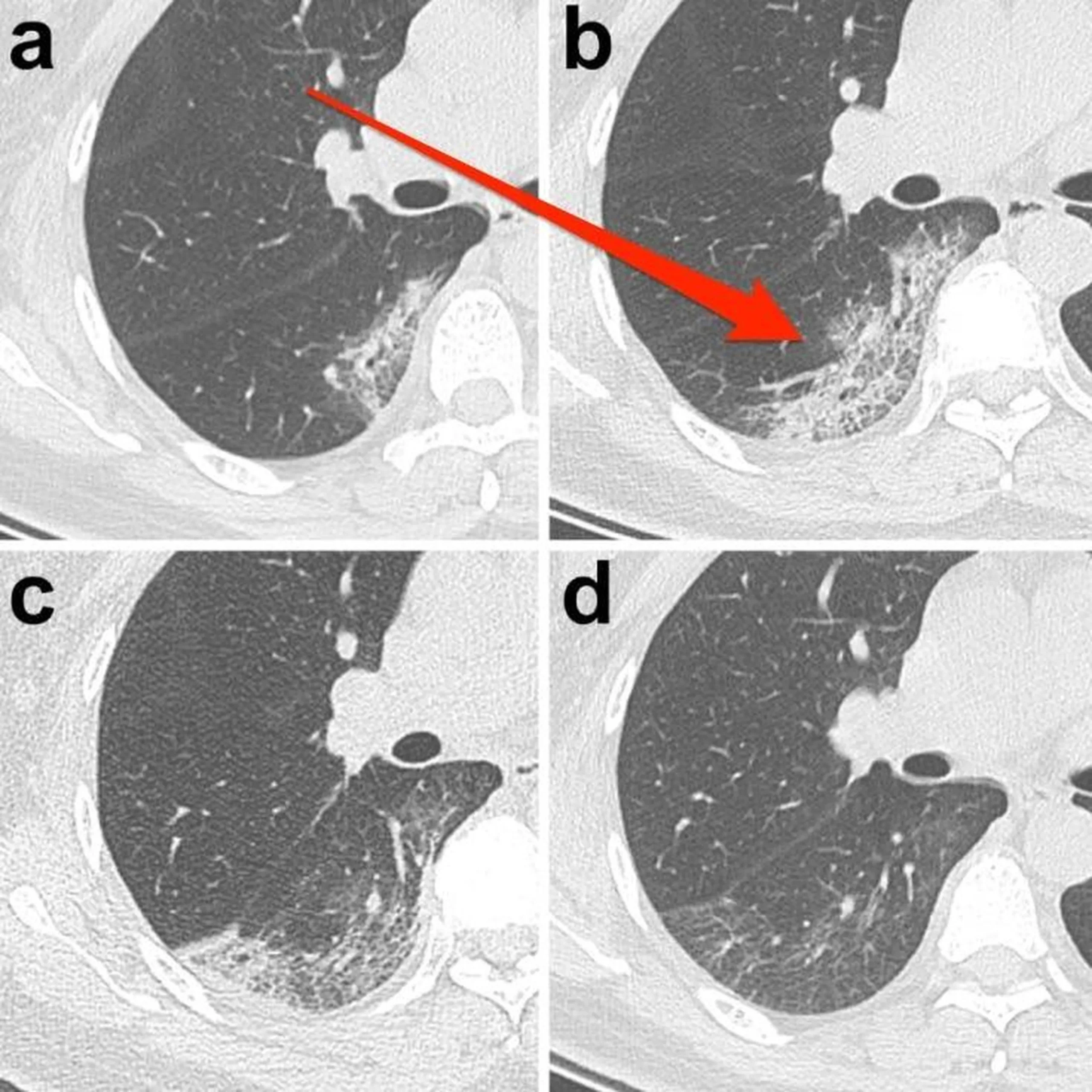 vidrio esmerilado pulmon - Qué significa tener opacidad en los pulmones
